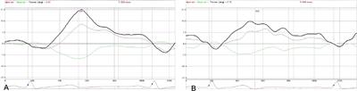 The Systolic and Diastolic Cardiac Function of Patients With Type 2 Diabetes Mellitus: An Evaluation of Left Ventricular Strain and Torsion Using Conventional and Speckle Tracking Echocardiography